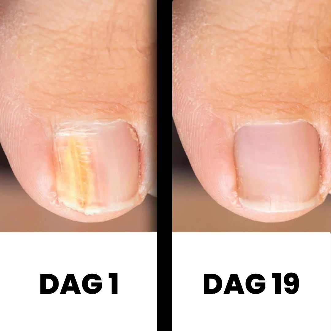 PureNail - Gepatenteerde nagelschimmeltherapie – voor gezonde nagels binnen 4 weken