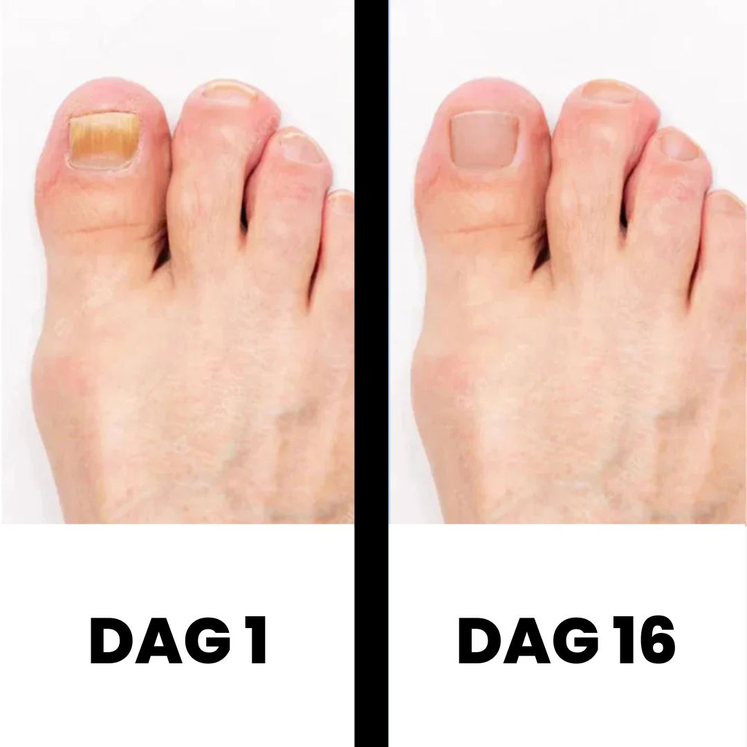 PureNail - Gepatenteerde nagelschimmeltherapie – voor gezonde nagels binnen 4 weken